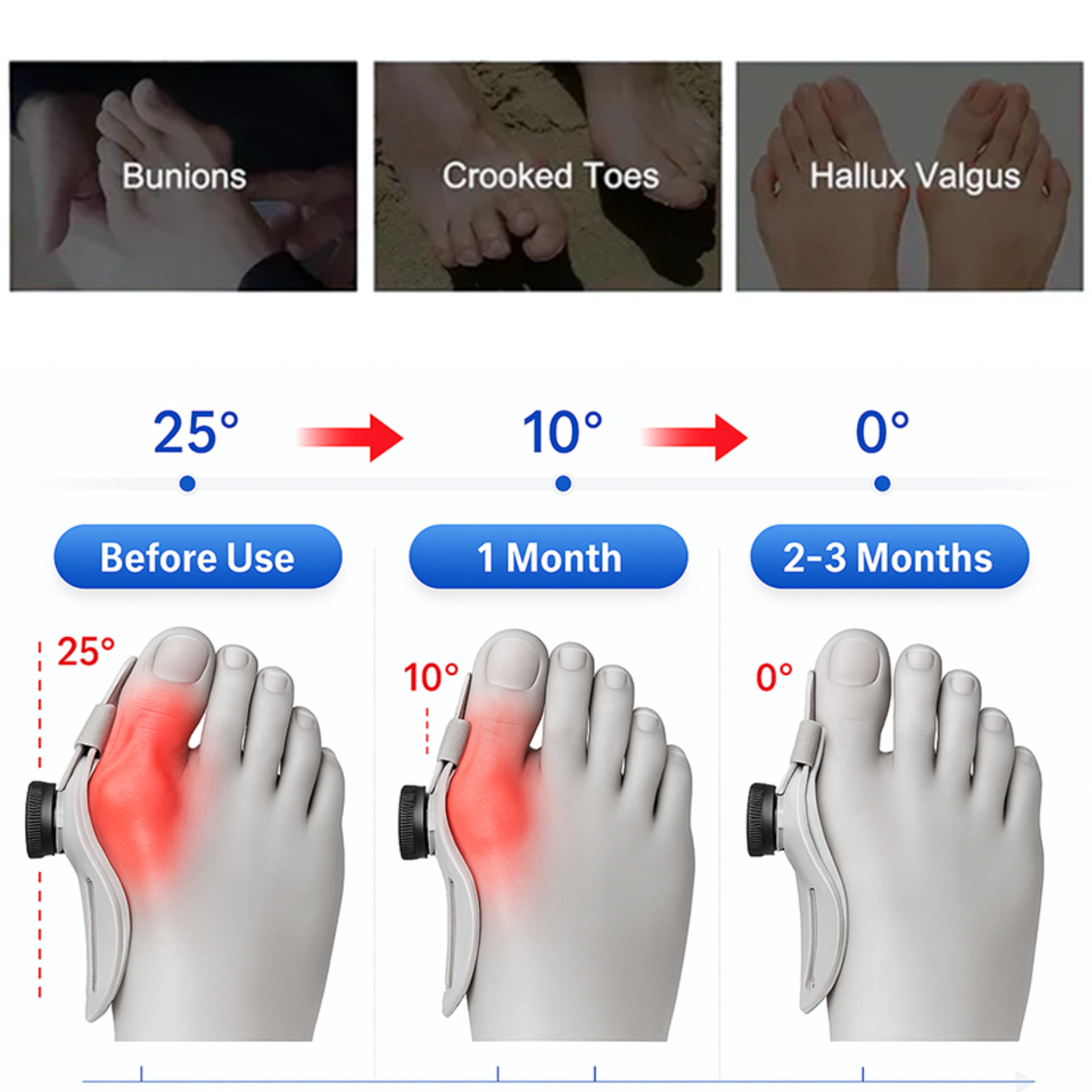 HalluxNext™ bunion Corrector
